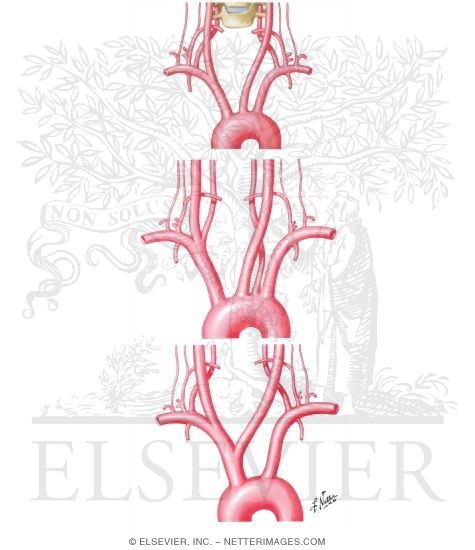 Watermarked preview of unlabeled image: Normal and Anomalous Origins of Common Carotid and Vertebral Arteries