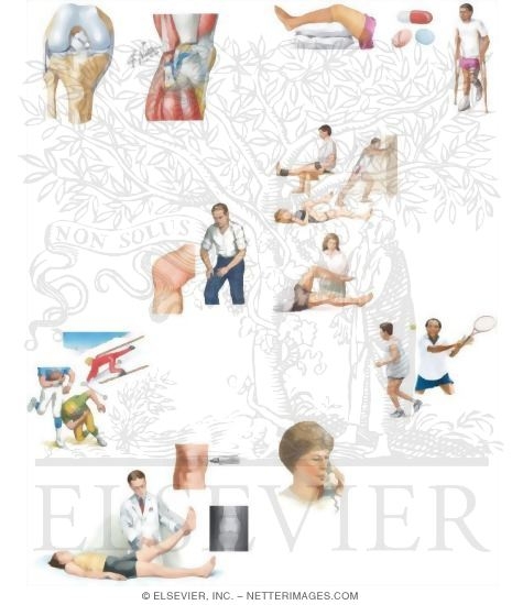 Watermarked preview of unlabeled image: Managing Your Knee Swelling