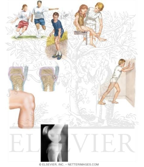 Watermarked preview of unlabeled image: Caring for Your Child With Osgood-Schlatter Disease