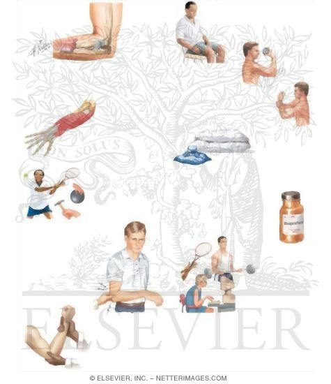 Managing Your Tennis Elbow
