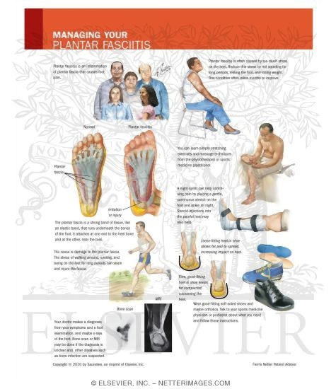 Watermarked preview of unlabeled image: Managing Your Plantar Fasciitis