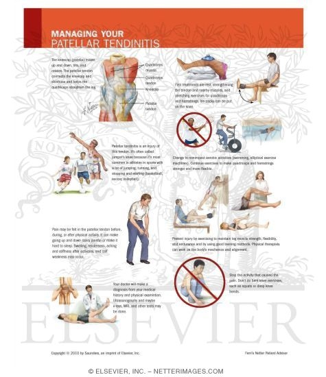 Watermarked preview of unlabeled image: Managing Your Patellar Tendinitis
