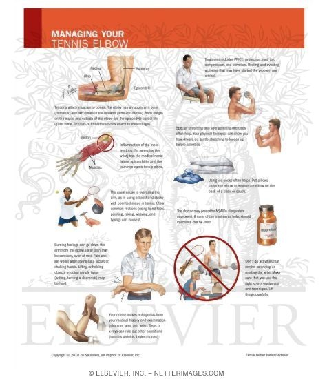 Watermarked preview of unlabeled image: Managing Your Tennis Elbow