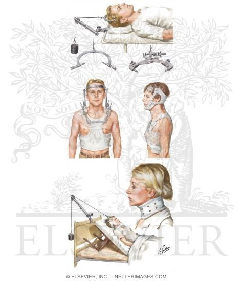 Cervical Spine Injury: Traction and Bracing