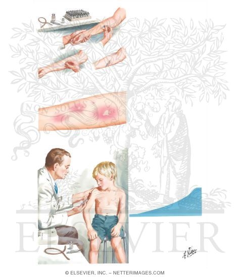 Bronchial asthma dissertation 06 picture