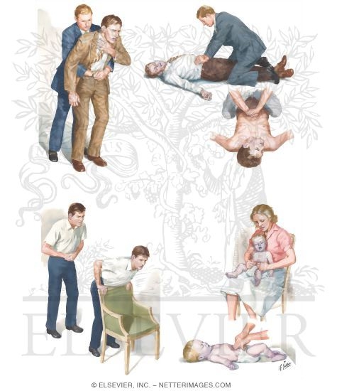 Upper Airway Obstruction: Heimlich Maneuver