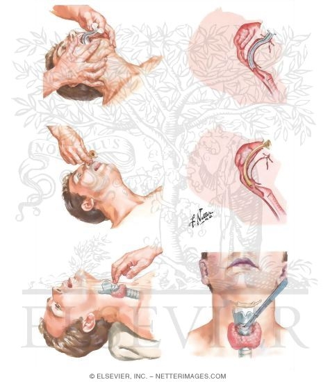 Patent Airway