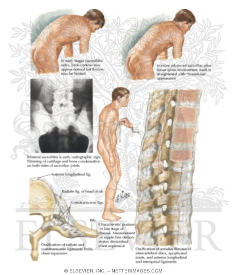 Watermarked preview of labeled image: Ankylosing Spondylitis