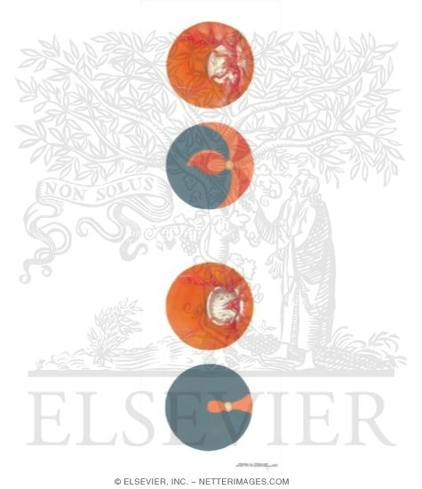 Watermarked preview of unlabeled image: Optic Disc and Visual Field Changes In Glaucoma