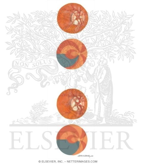Watermarked preview of unlabeled image: Optic Disc and Visual Field Changes In Glaucoma