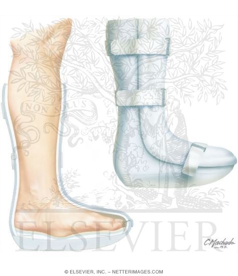 Watermarked preview of unlabeled image: Orthotics