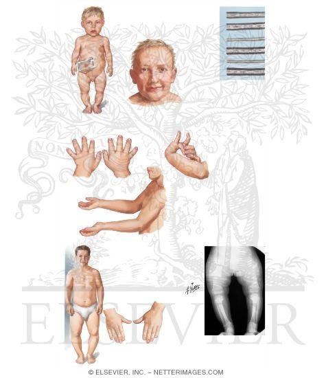 Metaphyseal Chondrodysplasia