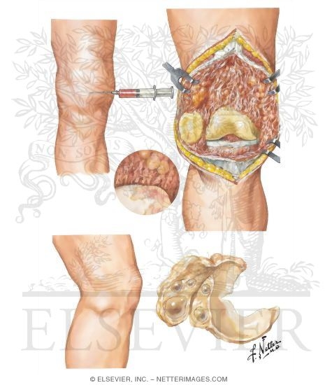 Watermarked preview of unlabeled image: Pigmented Villonodular Synovitis and Meniscal Cysts
