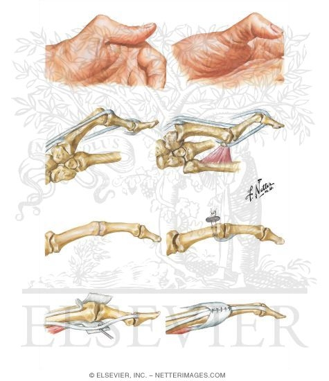 Watermarked preview of unlabeled image: Metacarpophalangeal Deformities of Thumb