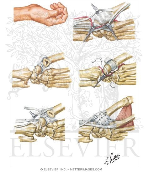 Watermarked preview of unlabeled image: Implant Resection Arthroplasty for Trapezium