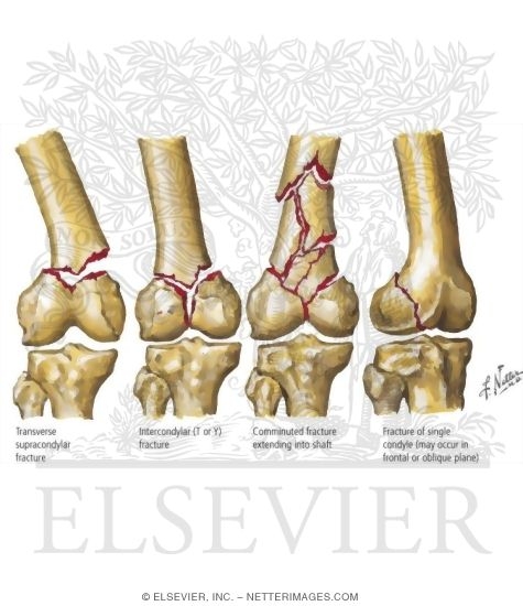 Fracture of Distal Femur