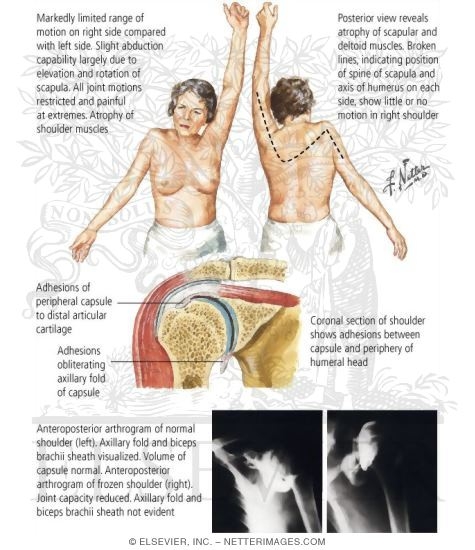 Watermarked preview of labeled image: Adhesive Capsulitis of Shoulder (Frozen Shoulder)