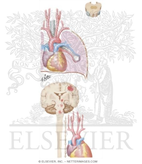 Watermarked preview of unlabeled image: Periodic Breathing (Cheyne-Stokes)