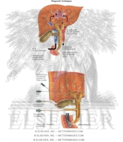 Watermarked preview of labeled image: Gallstones: Cholecystography and Cholangiography