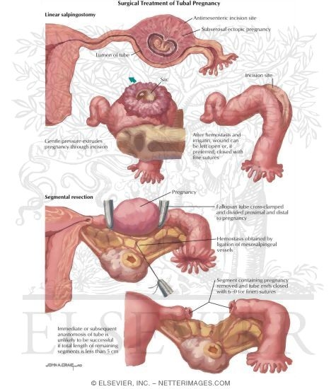 Watermarked preview of labeled image: Current Perspectives In Gynecology: Surgical Treatment Of Tubal Pregnancy
