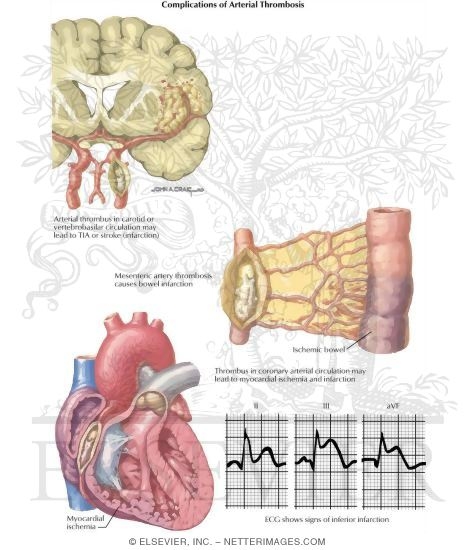 Watermarked preview of labeled image: Thrombotic Disorders: Complications of Arterial Thrombosis