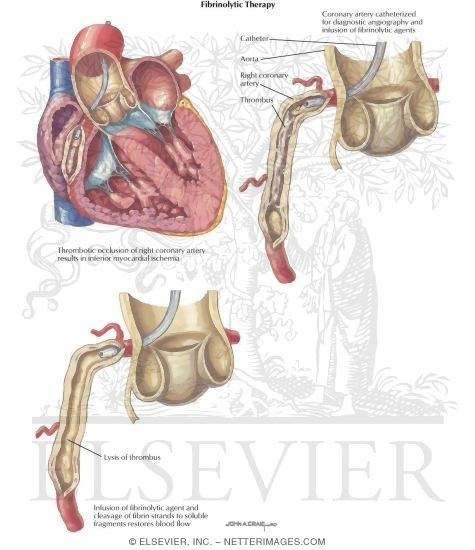 Watermarked preview of labeled image: Fibrinolytic Therapy