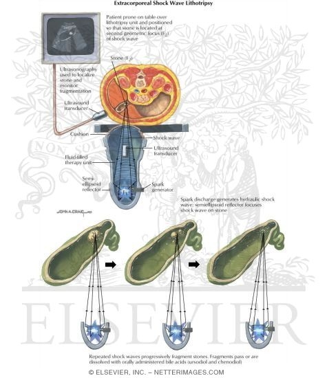 Gallstones: Extra Corporeal Shockwave Lithotripsy