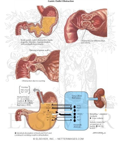 Gastric Outlet Obstruction