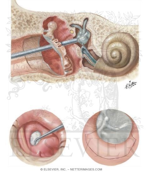 Watermarked preview of unlabeled image: Surgical Destruction of Labyrinth
