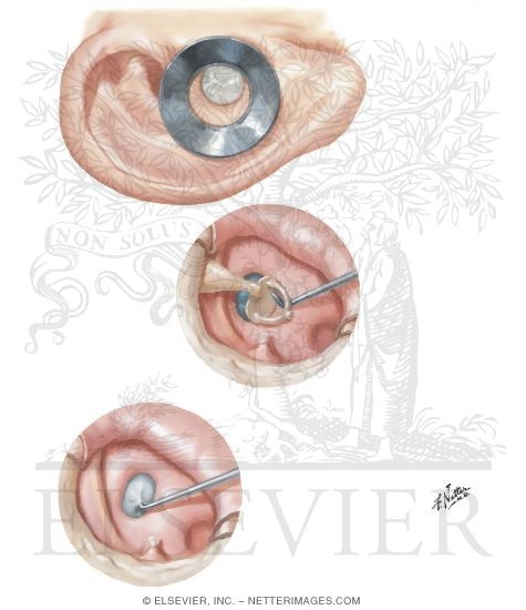 Watermarked preview of unlabeled image: Surgical Destruction of Labyrinth