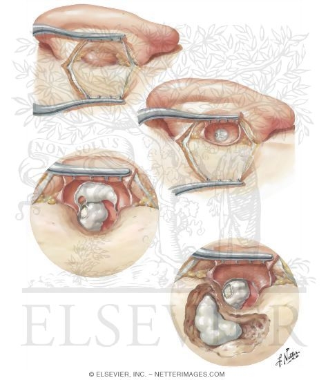 Watermarked preview of unlabeled image: Mastoid Approach for Removal of Cholesteatoma