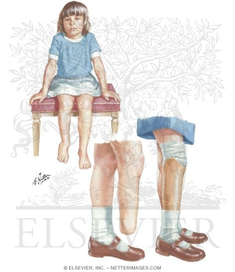 Watermarked preview of unlabeled image: Longitudinal Arrest: Fibular Ray Deficiency