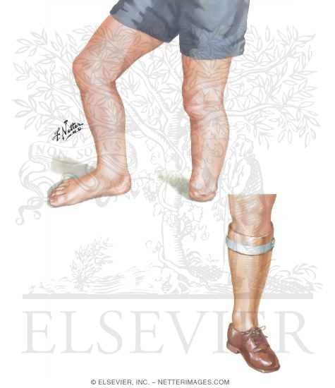 Watermarked preview of unlabeled image: Transverse Arrest of the Ankle: Disarticulation Type