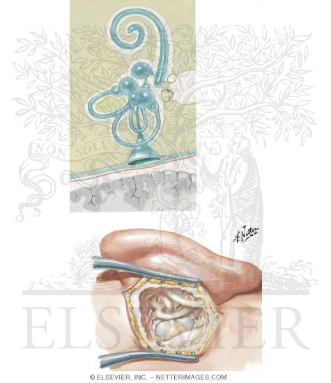 Endolymphatic Subarachnoid Shunt For Meniere S Disease For bilateral meniere's disease, ablative treatments are relatively contraindicated due to the risks of bilateral vestibular and cochlear hypofunction.