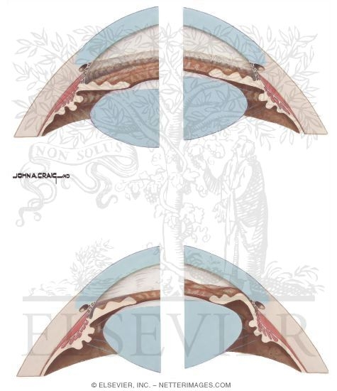 Grading of Chamber Angle By Gonioscopy