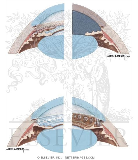 Traumatic Glaucoma