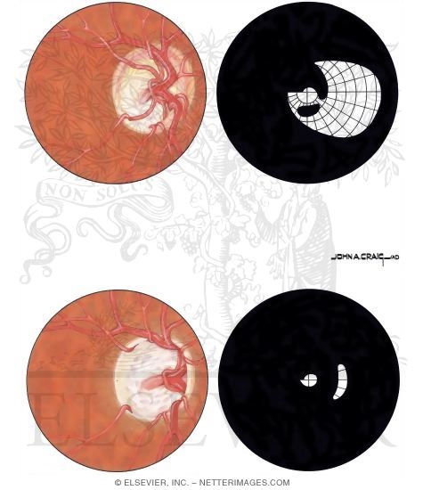 Optic Disc and Visual Field Changes In Glaucoma