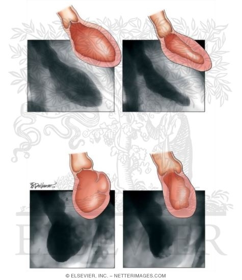 Watermarked preview of unlabeled image: Measurement of Left Ventricular Function Using Ventriculography