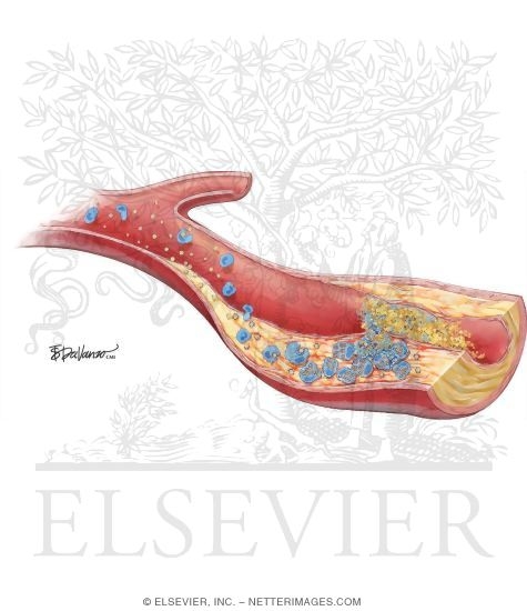 Watermarked preview of unlabeled image: Plaque Rupture and Inflammation