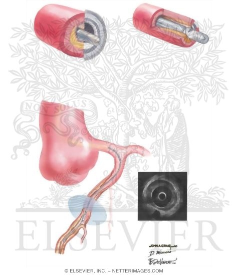 Watermarked preview of unlabeled image: Intravascular Ultrasound