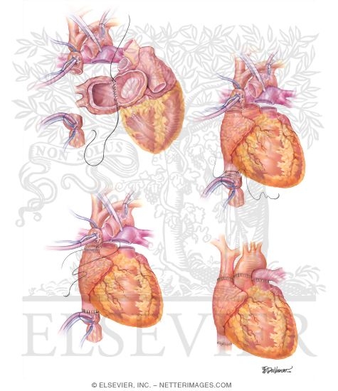 Technique of Bicaval Cardiac Transplantation