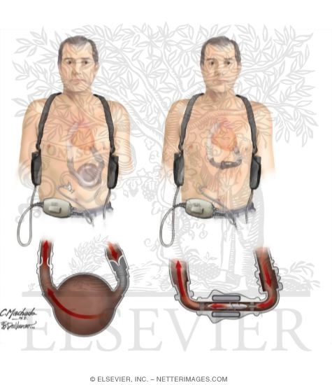 Watermarked preview of unlabeled image: HeartMate I and II Left Mechanical Circulatory Support Devices