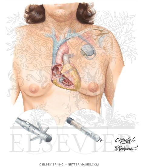 Watermarked preview of unlabeled image: Implantable Cardiac Pacemaker