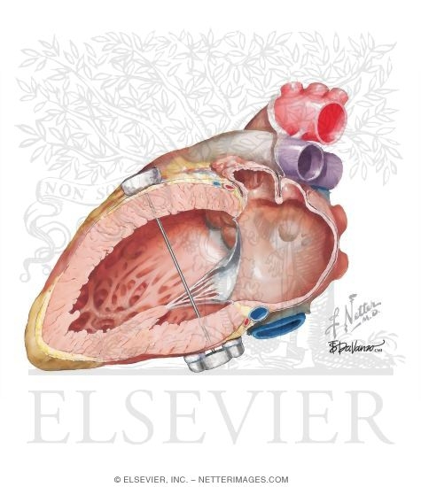 Watermarked preview of unlabeled image: Atrial Septal Defect