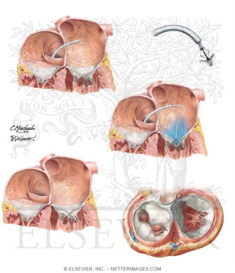 Watermarked preview of unlabeled image: Coronary Sinus Devices for Mitral Regurgitation