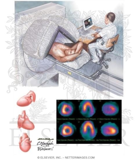 Stress Nuclear Imaging