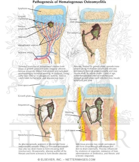 Watermarked preview of labeled image: Pathogenesis Of Hematogenous Osteomyelitis