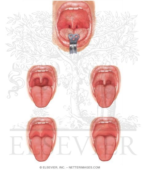 Watermarked preview of unlabeled image: Oral Cavity Evaluation for Sleep Apnea