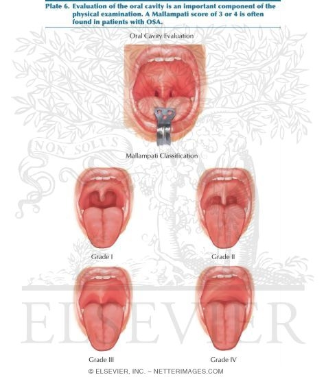 Watermarked preview of labeled image: Oral Cavity Evaluation for Sleep Apnea