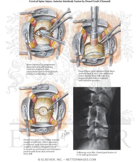 Watermarked preview of labeled image: Anterior Interbody Fusion by Dowel Graft